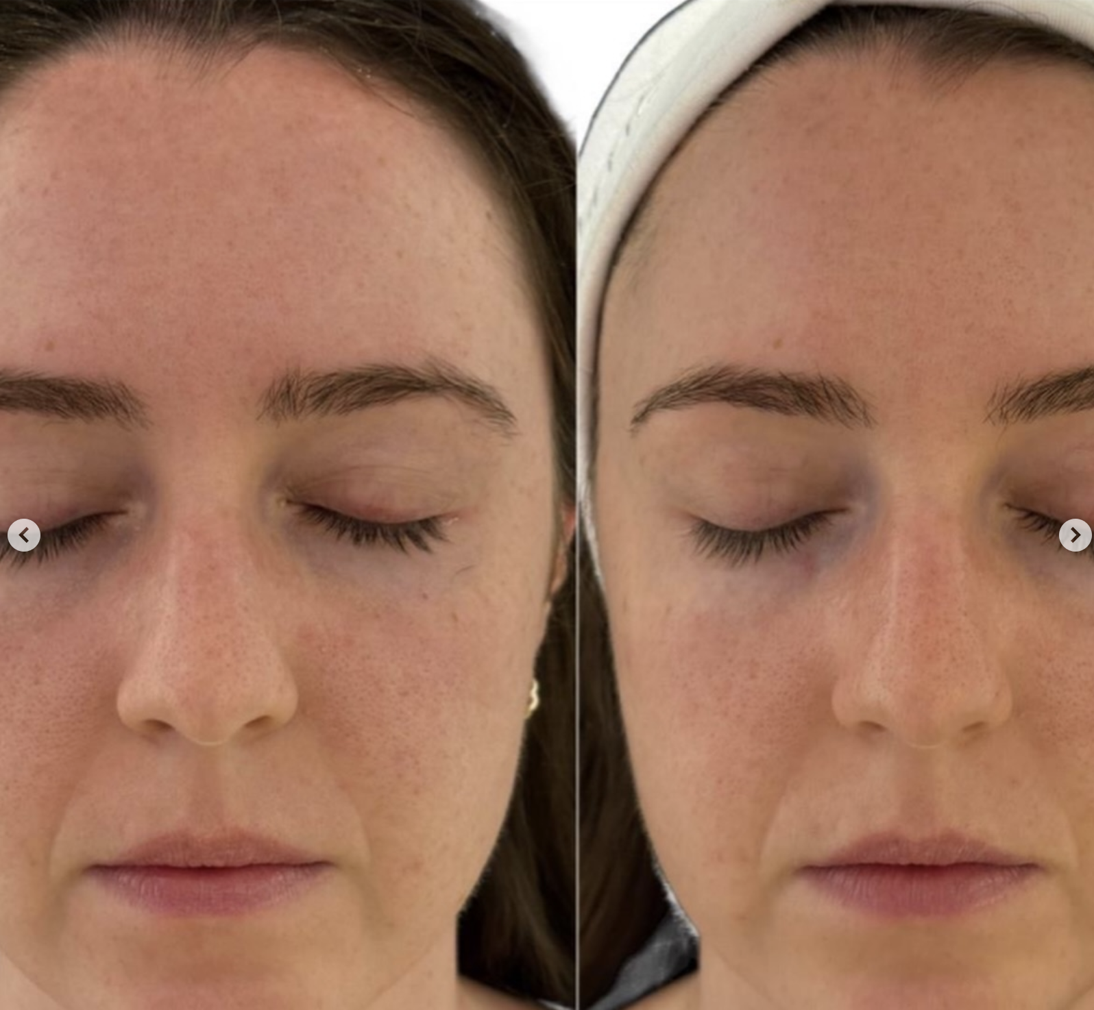 Client skin result 2, before and after treatment