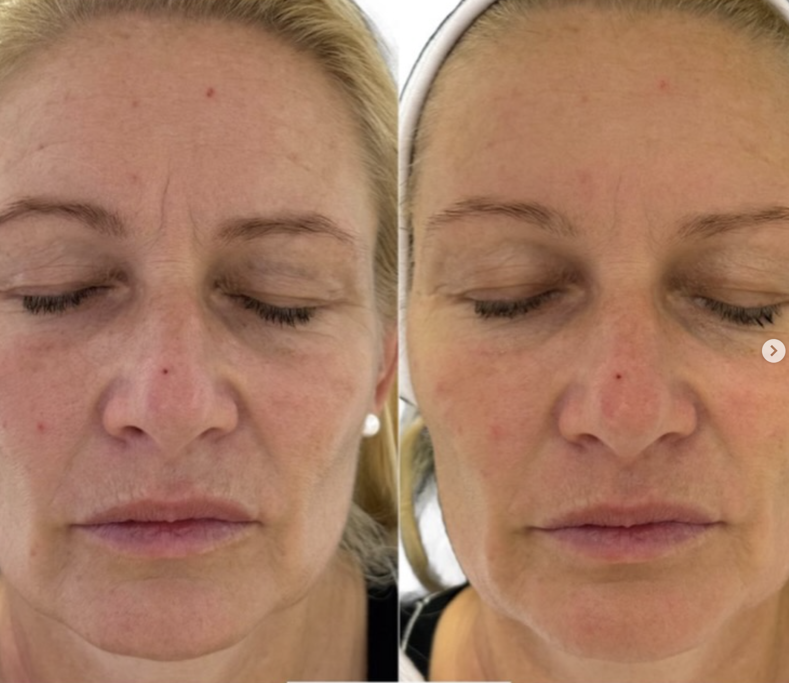 Client skin result 1, before and after treatment
