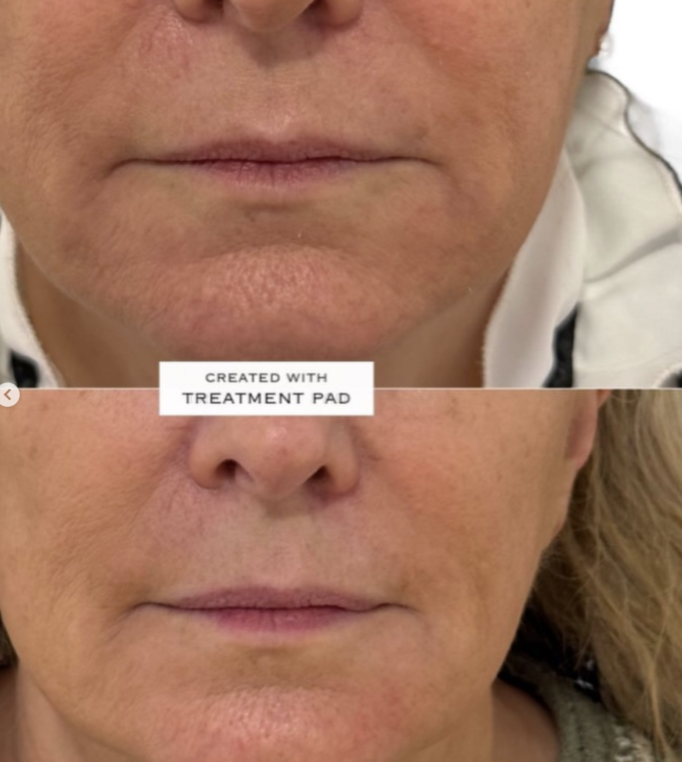 Client skin result 4, before and after treatment