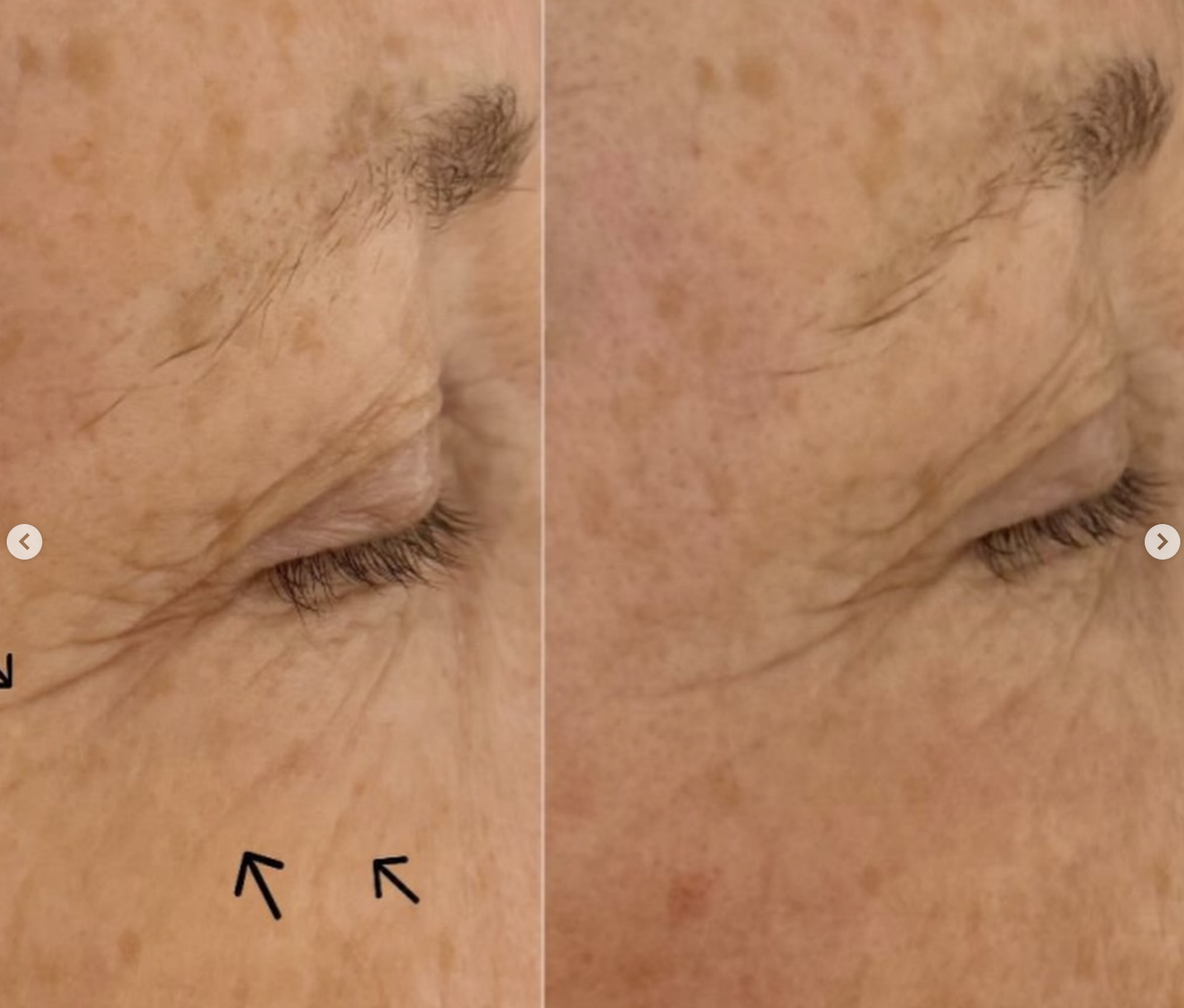 Client skin result 3, before and after treatment